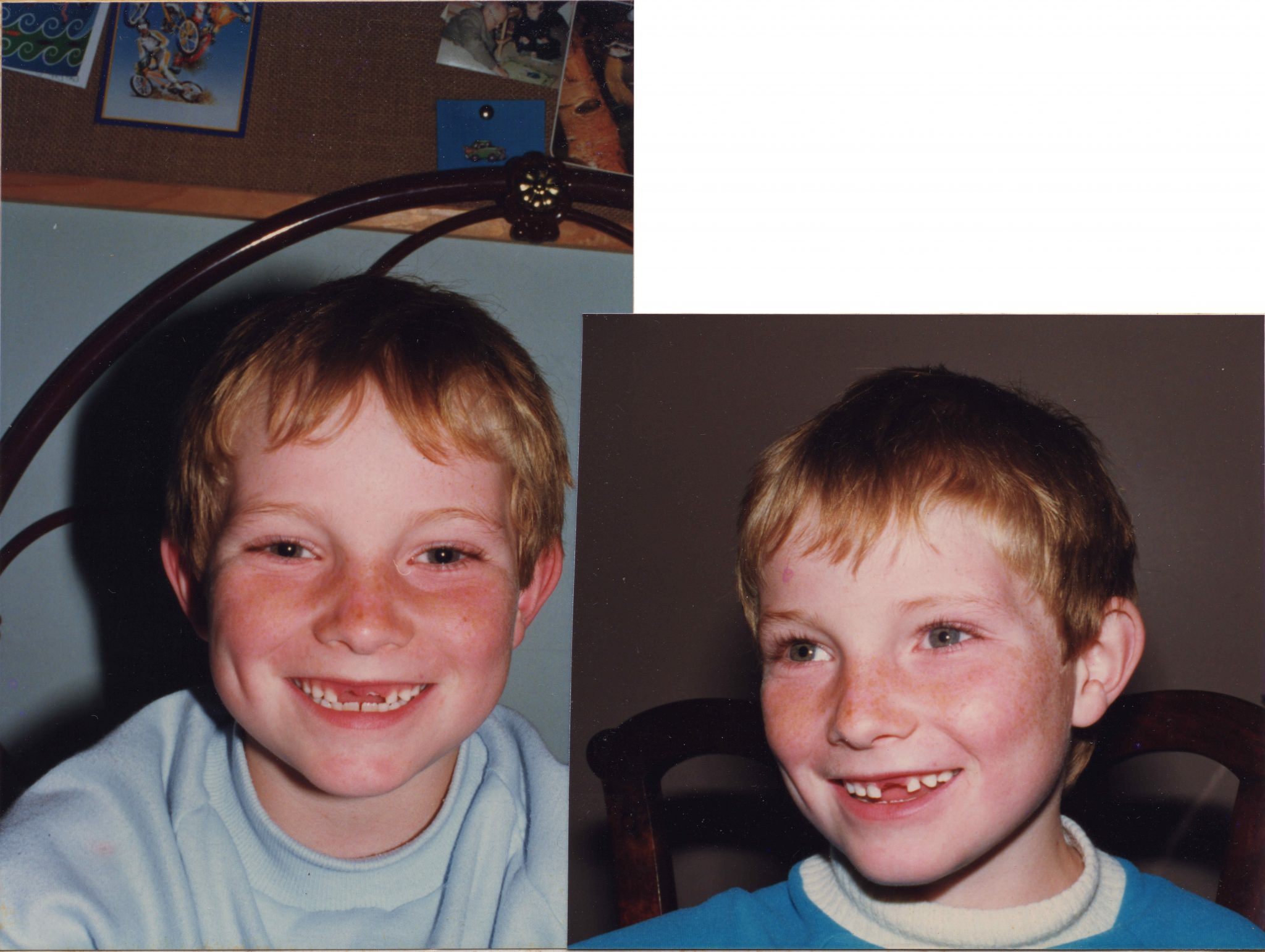 19860505 000001 missing front teeth